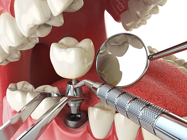 Best Chipped Tooth Repair Near Me  in Sun Valley, ID